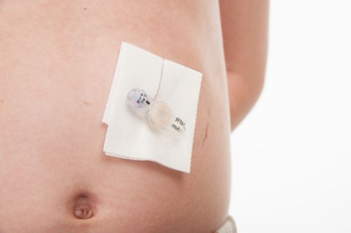 Taped catheter on child's stomach