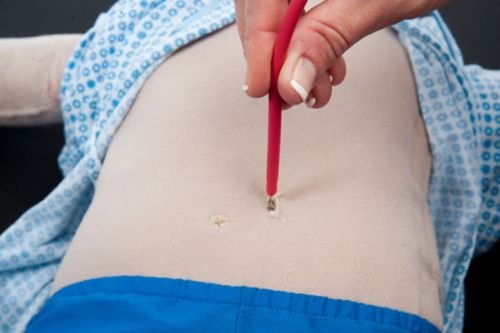 Inserting the catheter into the stoma