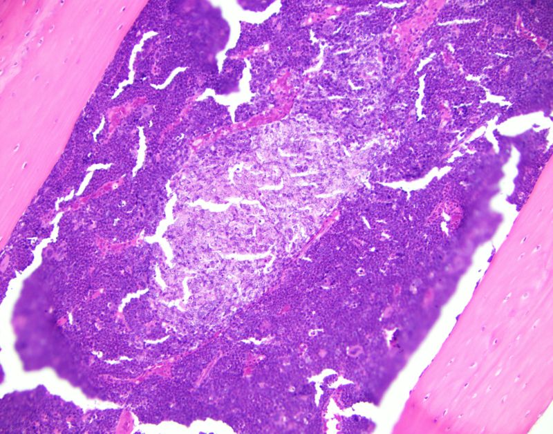 The presence of histiocytic granuloma in a genetic mouse model of AML 