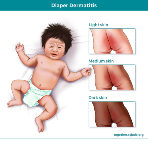 Diaper dermatitis on different skin tones