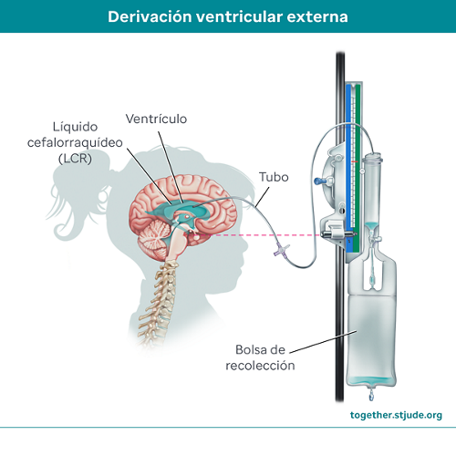 Una derivación es un pequeño tubo que drena el LCR para evitar la acumulación de líquido. 