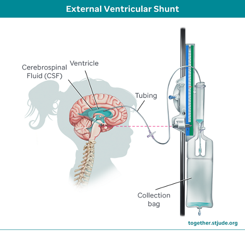 A shunt is a small tube that drains CSF to prevent a build-up of fluid. 
