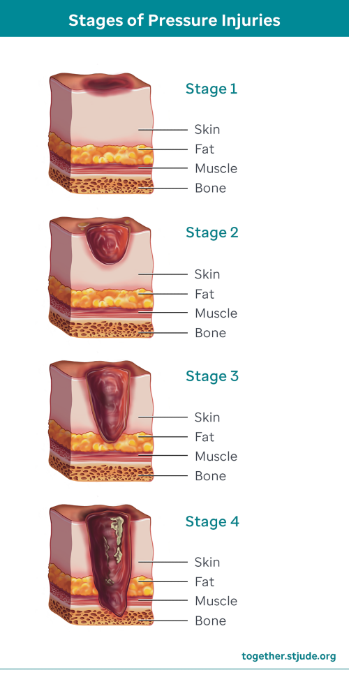 Different stages of pressure injuries