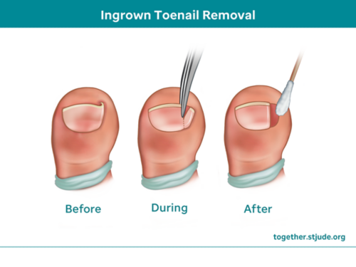Ingrown toenail removal
