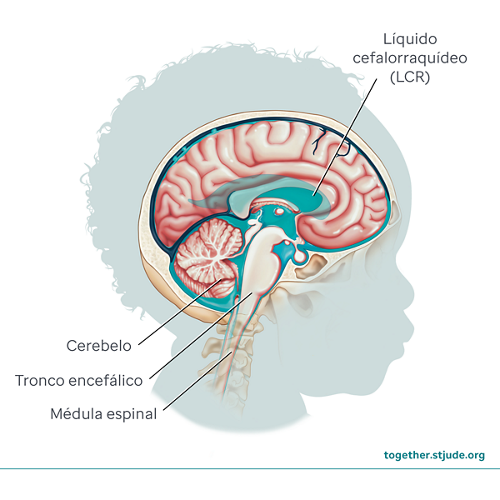 ¿Qué es el tumor de plexo coroideo? Los tumores de plexo coroideo se originan en los ventrículos del cerebro. Los ventrículos son cavidades en el cerebro que están llenas de líquido cefalorraquídeo. 