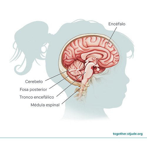 El meduloblastoma es un tumor cerebral que comienza en el cerebelo. El cerebelo se encuentra en una parte del cerebro llamada fosa posterior.