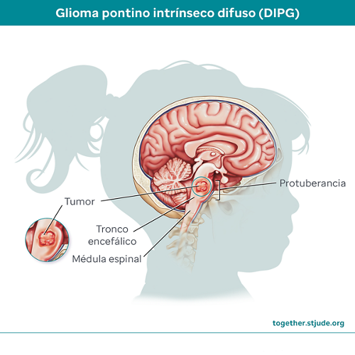El glioma pontino intrínseco difuso (DIPG) es un tumor cerebral agresivo. Comienza en el tronco encefálico en un área llamada la protuberancia. La protuberancia controla las funciones vitales, así como los nervios que controlan la visión, la audición, el habla, la deglución y el movimiento.