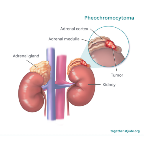 Illustration showing pheochromocytoma tumor on kidneys