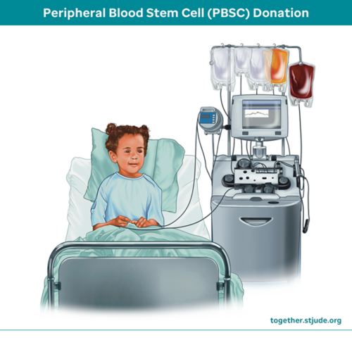 apheresis image showing saline bag, stem cells bag, apheresis machine