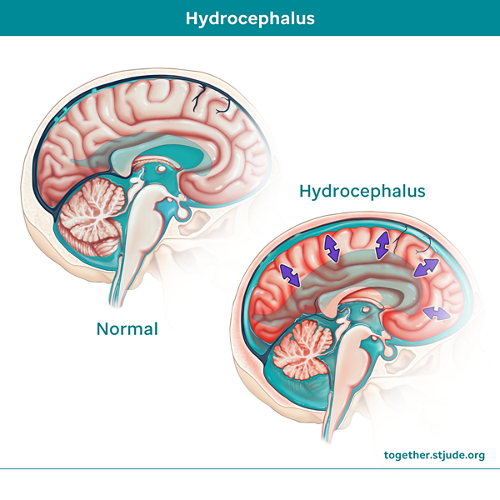 Sometimes an ependymoma can block the normal flow of cerebrospinal fluid (CSF). Hydrocephalus occurs when too much CSF builds up in the ventricles. 