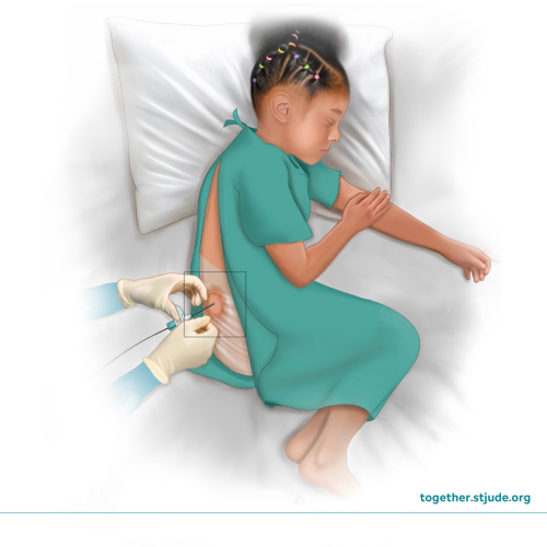 Illustration of child receiving epidural anesthesia