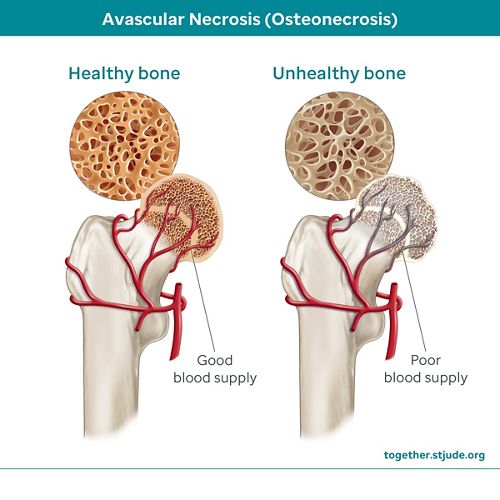 Healthy bone with good blood supply and unhealthy bone with poor blood supply