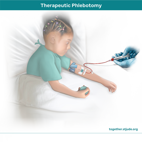 Illustration of female child undergoing therapeutic phlebotomy