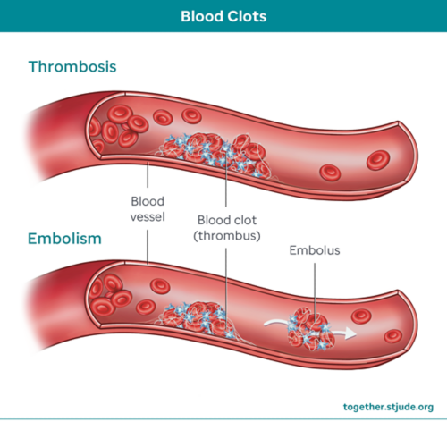 Blood clots: thrombosis and embolism