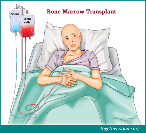 Medical illustration of cancer patient in hospital bed for bone marrow transplant with stem cells and saline IV bags
