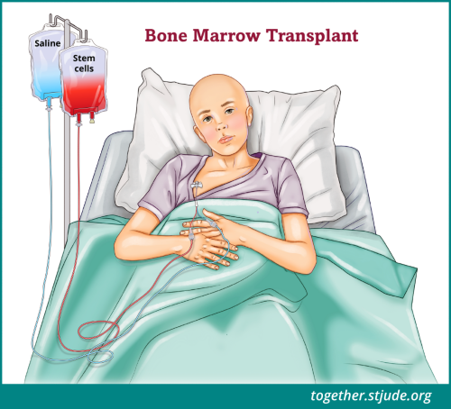 O tratamento do linfoma de Burkitt recidivado pode incluir um transplante de células-tronco.