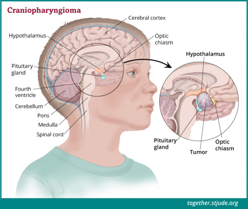 क्रेनियोफेरिन्जयोमा आमतौर पर पीयूष ग्रंथि और हाइपोथेलेमस के पास विकसित होते हैं। इस भाग में स्थित ट्यूमर एंडोक्राइन फ़ंक्शन को प्रभावित करते हैं। यदि ट्यूमर आंख की नस (तंत्रिका) के बिल्कुल निकट स्थित है, तो इससे दृष्टि भी प्रभावित हो सकती है।