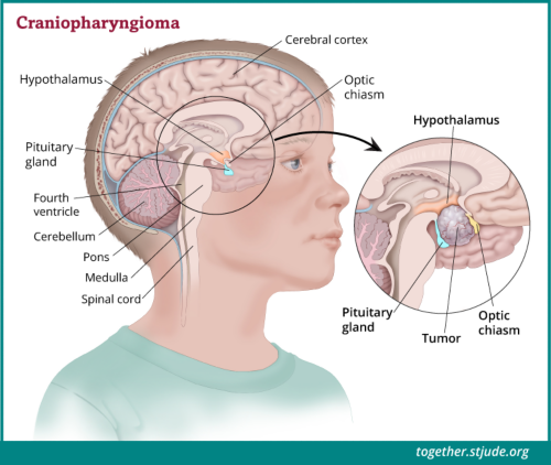 کرینیوفیرنجیوماس عام طور پر پٹیوٹری گلینڈ اور ہائپو تھیلمس کے قریب تیار ہوتے ہیں۔ اس حصے کے ٹیومرز انڈوکرائن کے فنکشن کو متاثر کرتے ہیں۔ اگر ٹیومر آپٹک اعصاب کے قریب ہے تو، بینائی بھی متاثر ہوسکتی ہے۔