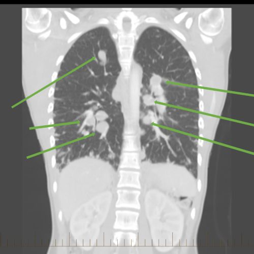 TC del tórax de un paciente con sarcoma de Ewing, con marcas para mostrar la metástasis