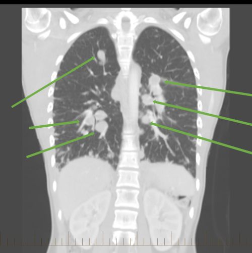 मेटास्टेसिस या कैंसर के फैलाव को दिखाने के लिए चिह्नांकनों के साथ एक ईविंग सारकोमा रोगी की छाती का सीटी स्कैन