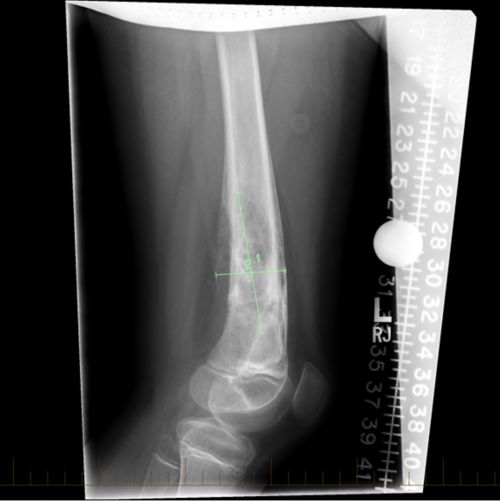 Рентгенівський знімок стегнової кістки дитини з онкологічним захворюванням із позначками, що вказують на саркому Юінга