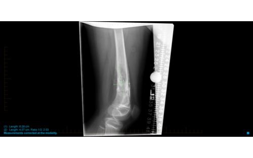 X-ray of ewing sarcoma in femur