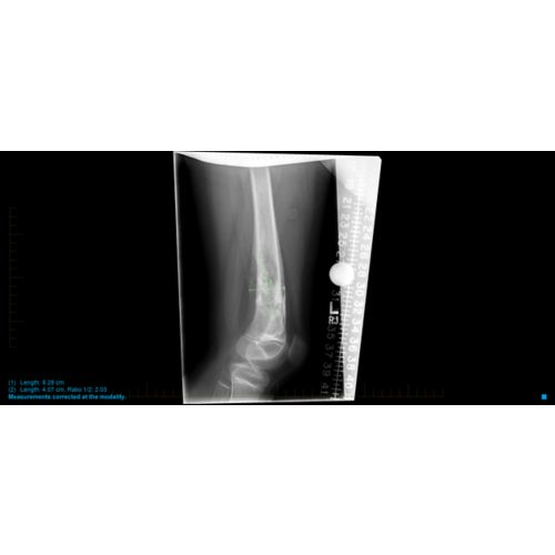 Sarcoma de Ewing