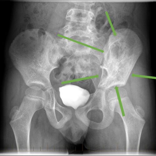 На рентгенівському знімку показано саркому Юінга на стегні дитини з онкологічним захворюванням