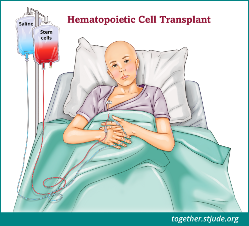 There are two basic types of transplants: allogeneic (blood-forming cells come from a donor) and autologous (the patient’s own cells are used). A patient receives cells from the donor through a vein in a process much like a blood transfusion. The cells travel through the bloodstream to the center of the long bones. The transplanted cells restore the patient’s ability to make healthy red blood cells, white blood cells, and platelets.