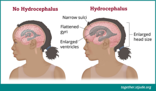 Às vezes, os tumores cerebrais podem bloquear o fluxo normal do líquido cefalorraquidiano (LCR). A hidrocefalia ocorre quando há acúmulo excessivo de LCR nos ventrículos.
