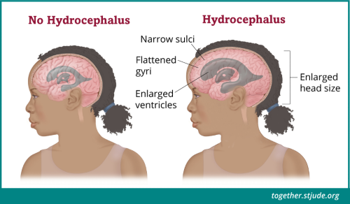 ہائیڈروسیفالس علامات کی وجہ بنتا ہے جیسے سر درد، متلی کمزوری، اور چلنے پھرنے میں دشواری۔ اسٹیرایڈ ادویات دماغی سوزش اور دباؤ کو کم کرتی ہیں، لیکن ان کے مضر اثرات بھی ہوتے ہیں۔ وزن میں اضافہ، چہرے کی سوجن اور پھلاؤ بنیادی طور پر کورٹیکوسٹیرائڈ ادویات کی زیادہ مقدار کی وجہ سے ہے۔