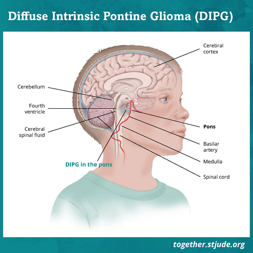 What is DIPG? Diffuse intrinsic pontine glioma (DIPG) is an aggressive brain tumor that begins in the brainstem in an area called the pons. The pons is responsible for vital life functions as well as the nerves that control vision, hearing, speech, swallowing, and movement.
