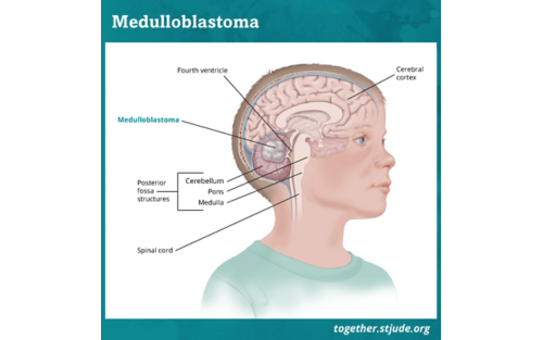 Medical illustration of a brain with medulloblastoma