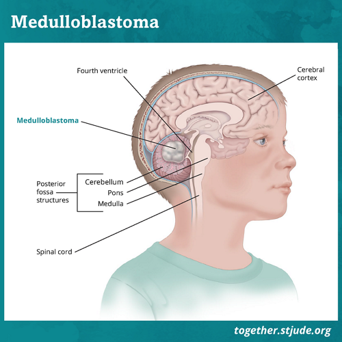 Posterior Fossa Syndrome - Together by St. Jude™