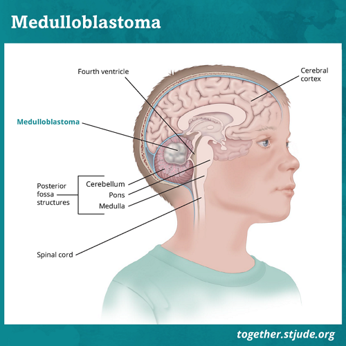 Що являє собою медулобластома? Медулобластома — це пухлина головного мозку в мозочку. Мозочок знаходиться в області головного мозку, що називається задньою ямкою.