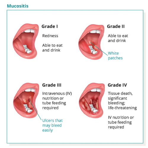 En la ilustración se muestran diferentes grados de mucositis; desde el grado 1 hasta el grado 4