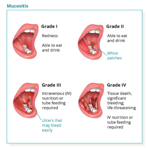 Illustration showing different grades of mucositis from grade 1 through grade 4