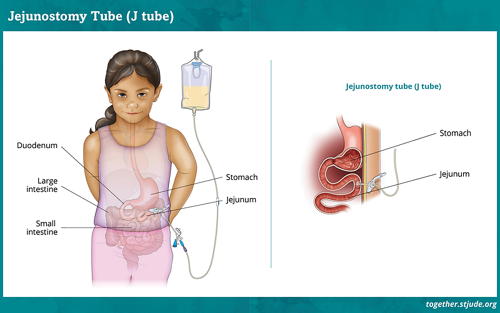 Ілюстрація процесу вводу єюностомічного зонду у шлунок