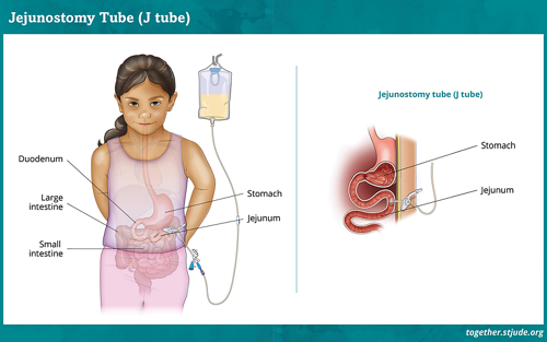 Diagram of a Jejunostomy Tube placed through the abdomen and into the stomach. 