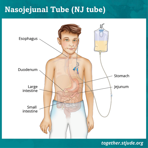 Nasal feeding deals tube