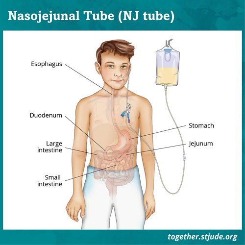 Illustration of a Nasojejunal Tube through the nasal cavity of a person