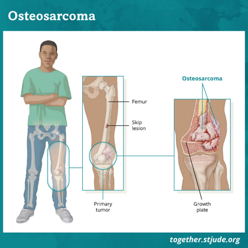 Osteosarcoma is a type of bone cancer. Osteosarcoma may develop in any bone, but it usually forms in the wide ends of long bones of the leg or arm. Osteosarcomas may form inside the bone (central tumors) or on the outer surface of bone (surface tumors). Most pediatric osteosarcomas are centrally located inside the bone. Imaging tests such as X-ray may be used to check for skip lesions. A skip lesion occurs when the cancer spreads away from the primary tumor to other parts of the bone.