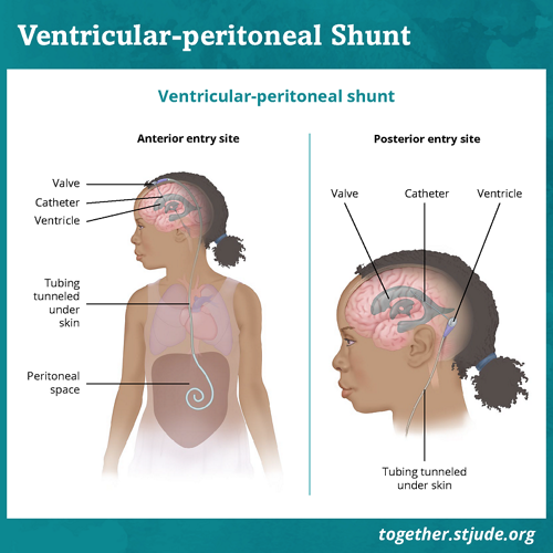 Un shunt est un petit tube qui draine le liquide céphalorachidien afin de l'empêcher de s'accumuler dans le cerveau. Ce liquide exerce une pression accrue à l'intérieur du cerveau et peut provoquer d'autres symptômes de tumeurs du plexus choroïde.