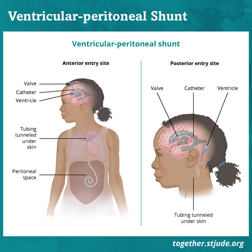 These illustrations show a girl with a shunt placed. The different versions show what the shunt looks like when placed towards the front of the body and towards the back of the body. The illustration is labeled to identify parts of the device: valve, catheter, tubing. A ventricle in the brain and the peritoneal space where the shunt drains are also labeled.