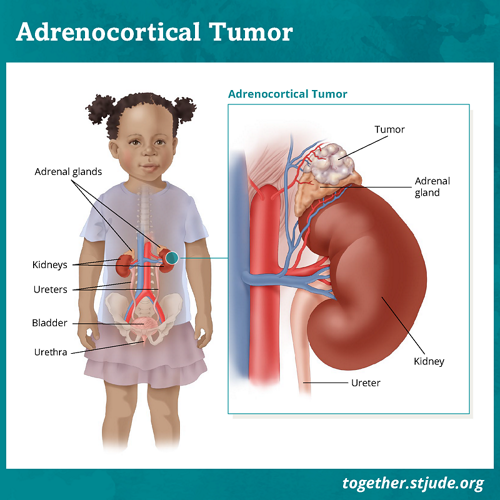 What is adrenocortical tumor? Adrenocortical tumor is a rare tumor of the adrenal gland. The adrenal glands are located on top of each kidney. The job of the adrenal glands is to produce hormones such as cortisol and aldosterone.