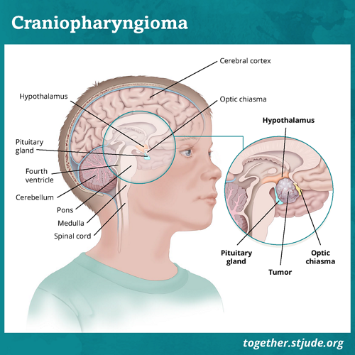 Surgery to remove fluid, Brain and spinal cord tumours