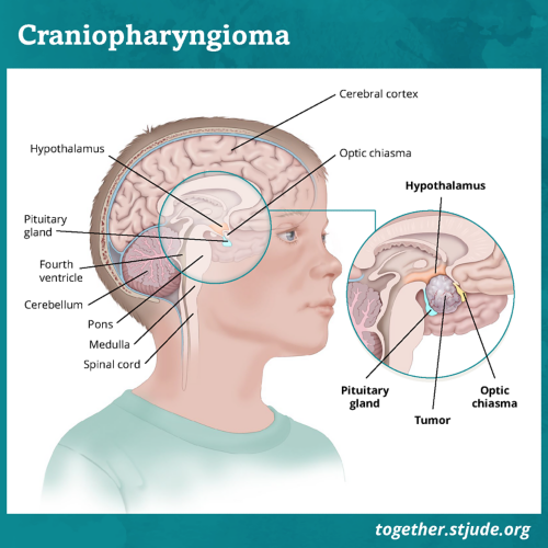 Craniopharyngiomas usually develop near the pituitary gland and hypothalamus. Tumors in this area affect endocrine function. If the tumor is near the optic nerve, vision may also be affected.