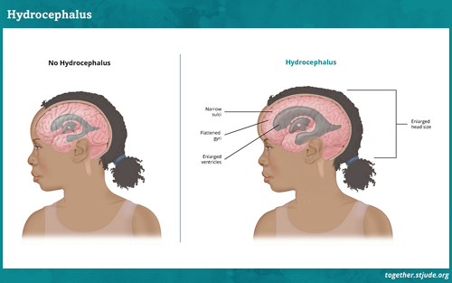 What is hydrocephalus? As the tumor grows, it may block the normal flow of cerebrospinal fluid. This causes a build-up of fluid within the brain known as hydrocephalus.
