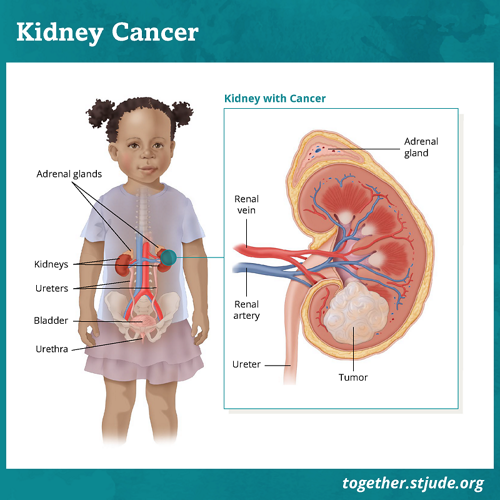 kidney cancer stages