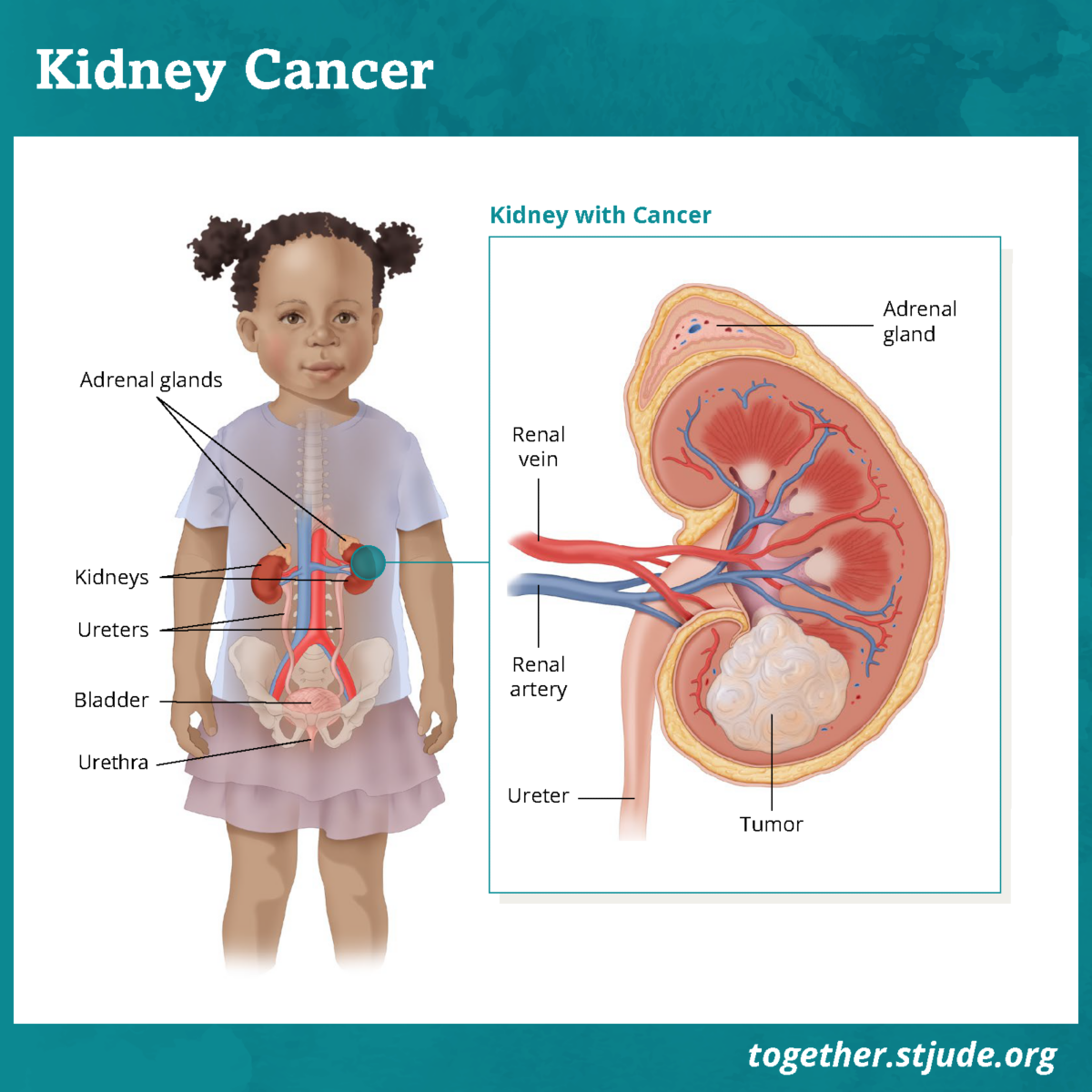 Renal Cell Carcinoma - Kidney Tumors in Children and Teens - Together by St. Jude™